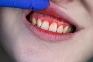 Suplimentele comune rivalizează cu antibioticele în tratamentul bolilor severe ale gingiilor