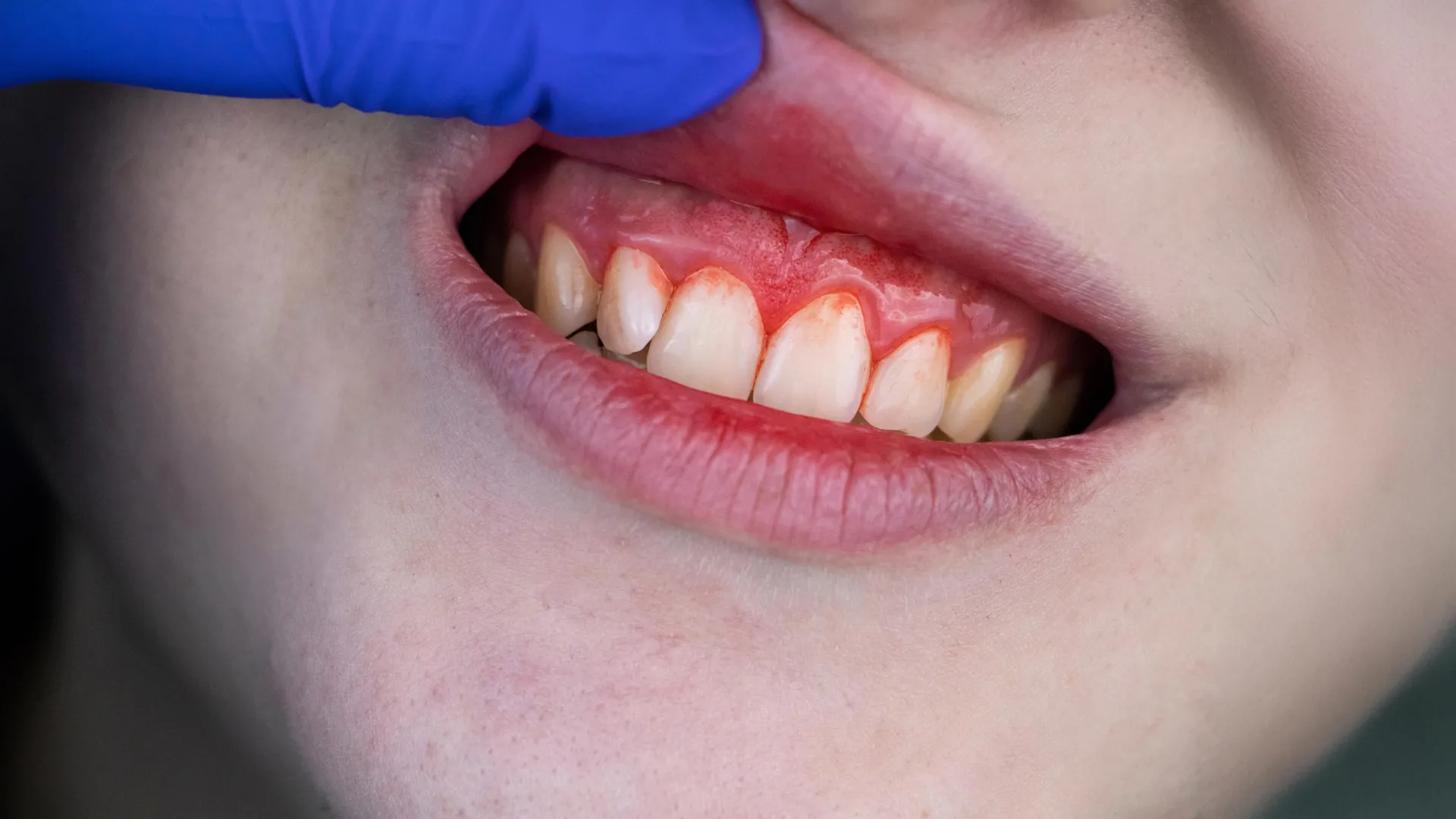 Suplimentele comune rivalizează cu antibioticele în tratamentul bolilor severe ale gingiilor