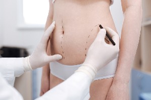 Care sunt beneficiile și riscurile liposucției?
