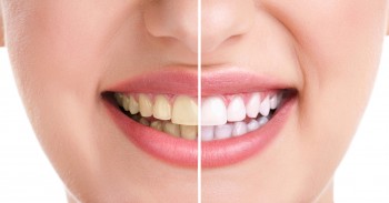 home_remedies_for_white_teeth.jpg